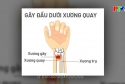 Gãy kín đầu dưới xương quay ở người cao tuổi