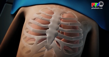 Phẫu thuật lõm lồng ngực bẩm sinh